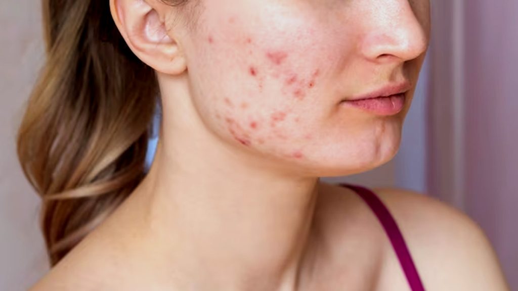Content image for The Link Between Hormones and Acne: What You Need to Know