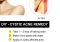 Featured image for The Ultimate Guide to Treating Cystic Acne