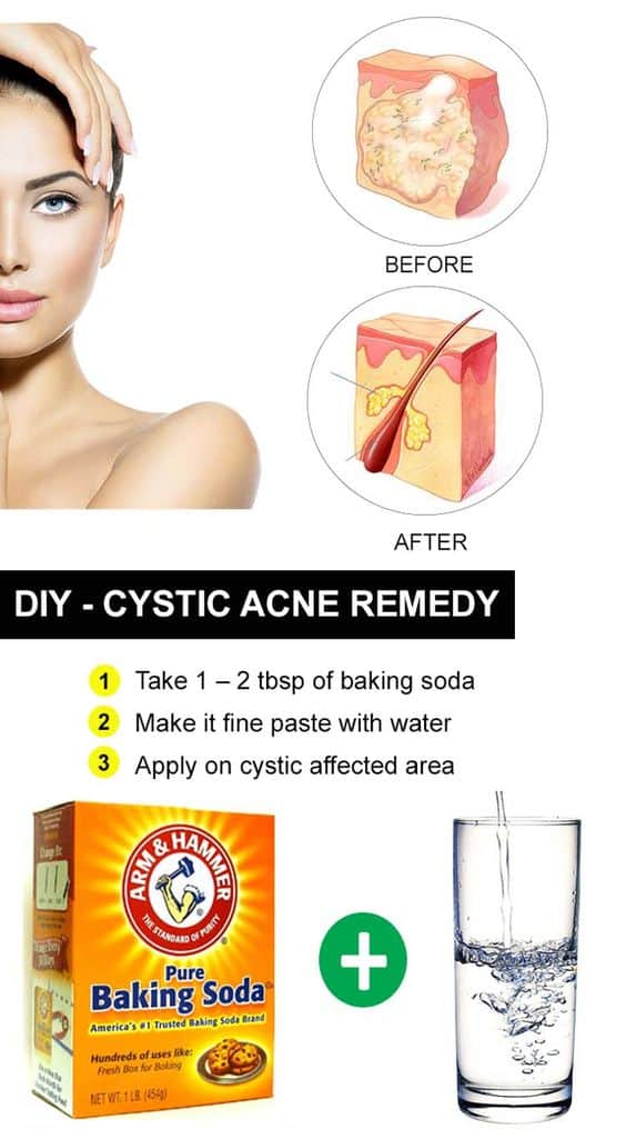 Featured image for The Ultimate Guide to Treating Cystic Acne