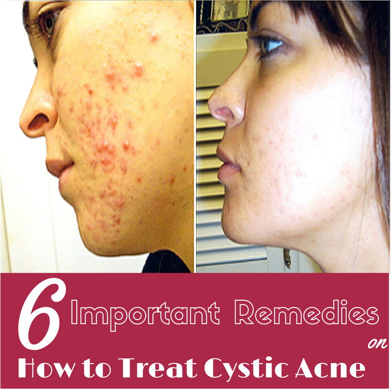 Content image for The Ultimate Guide to Treating Cystic Acne