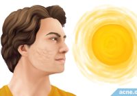 Featured image for Acne and Sun Exposure: What You Need to Know