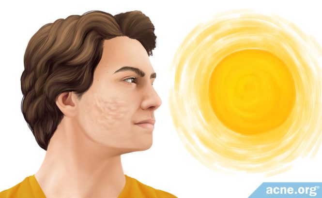 Featured image for Acne and Sun Exposure: What You Need to Know