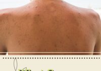 Featured image for How to Prevent and Treat Back Acne