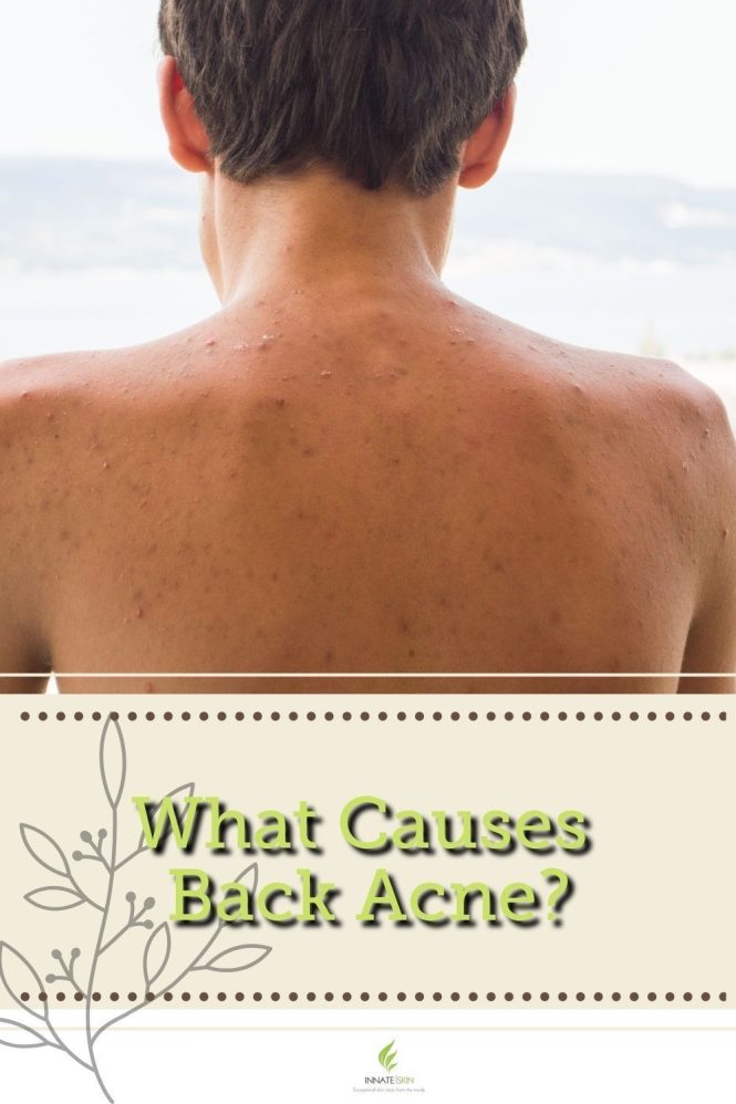 Featured image for How to Prevent and Treat Back Acne