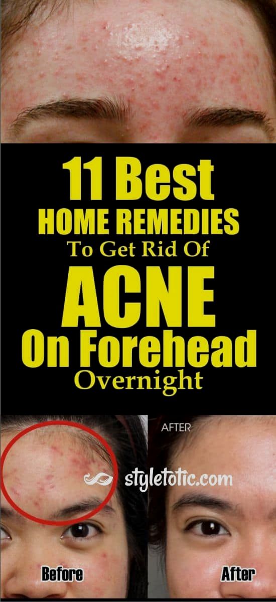 Featured image for How to Get Rid of Acne Overnight: Quick Fixes