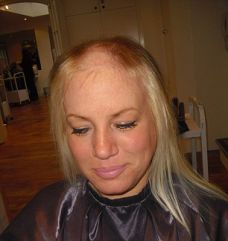Featured image for Hair Loss and Stress: How They're Connected and What You Can Do