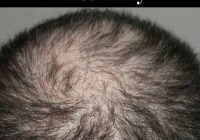 Featured image for How to Get Rid of Hair Loss Naturally