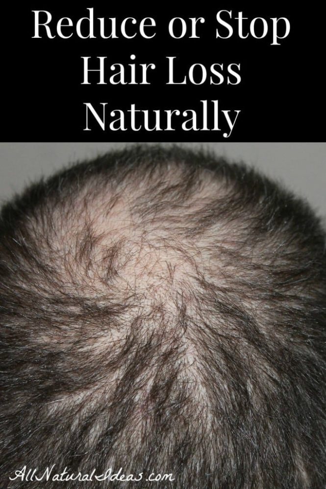 Featured image for How to Get Rid of Hair Loss Naturally