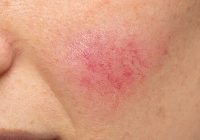 Featured image for Understanding and Treating Rosacea: A Complete Skincare Routine.
