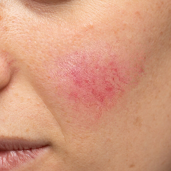 Featured image for Understanding and Treating Rosacea: A Complete Skincare Routine.
