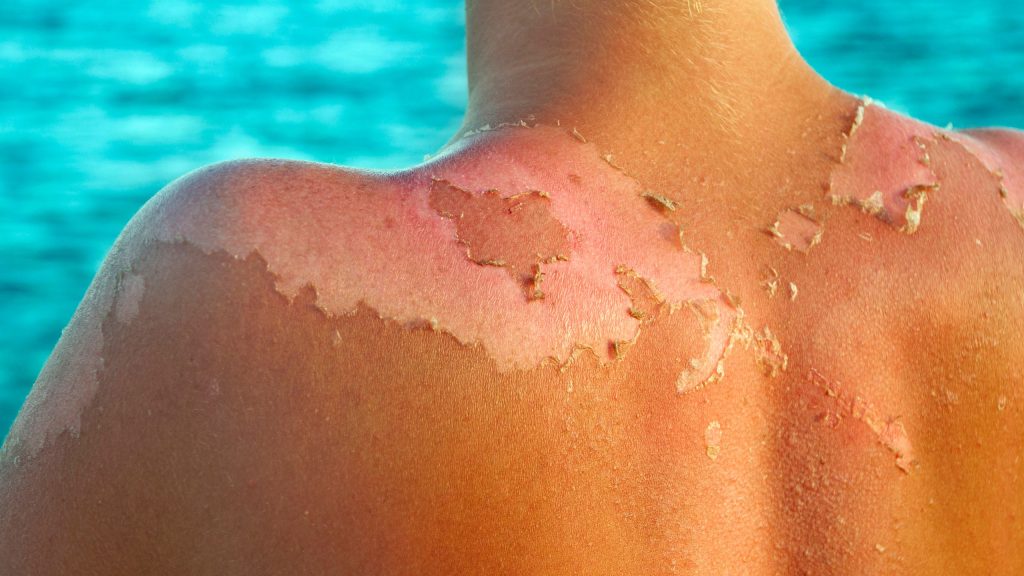 Content image for Sunburn SOS: How to Heal and Protect Your Skin After Sun Exposure.