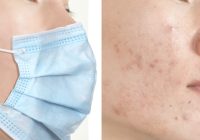 Featured image for Maskne No More: Preventing and Treating Acne from Face Masks.