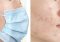 Featured image for Maskne No More: Preventing and Treating Acne from Face Masks.