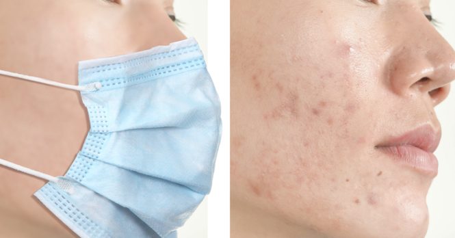 Featured image for Maskne No More: Preventing and Treating Acne from Face Masks.