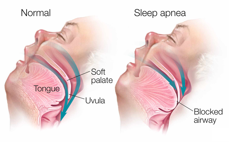 Content image for Sleep Apnea Solutions: Treatments for Restful Nights and Healthy Days.
