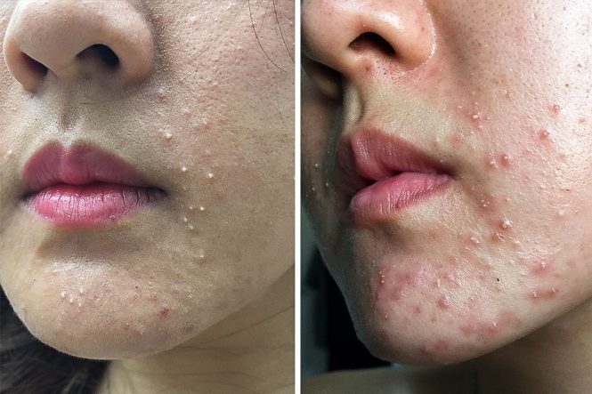 Featured image for Eczema Breakthrough: New Treatments for Soothing Irritated Skin.