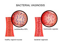 Featured image for Vaginal Health: Common Infections and Maintaining Balance.