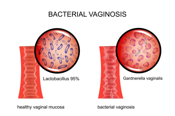 Featured image for Vaginal Health: Common Infections and Maintaining Balance.